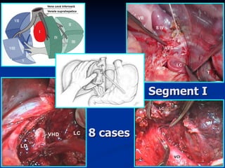 Segment I 8 cases 