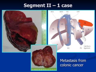 Segment I I  – 1 case Metasta sis from colonic cancer 