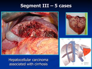 Segment III –  5  ca ses Hepatocellular carcinoma associated with cirrhosis 