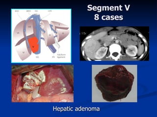 Segment V 8 ca ses Hepatic adenoma 