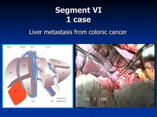 Segment VI 1 case Liver metastasis from colonic cancer 