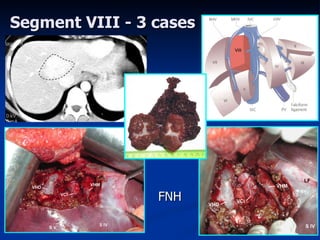 Segment VIII  -  3 ca ses FNH 