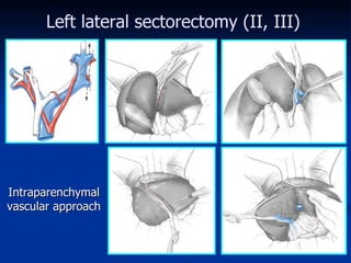 Left lateral sectorectomy  (II, III) Intraparenchymal vascular approach 