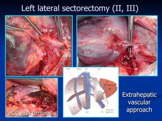 Extrahepatic vascular approach HCC with cirrhosis Left lateral sectorectomy  (II, III) 