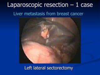 Laparoscopic resection  – 1 ca se Liver metastasis from breast cancer Left lateral sectorectomy 