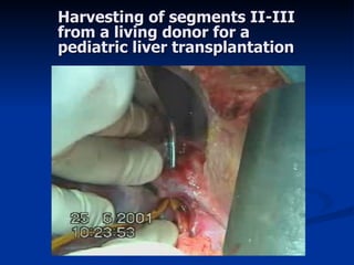 Harvesting of segments II-III from a living donor for a pediatric liver transplantation 