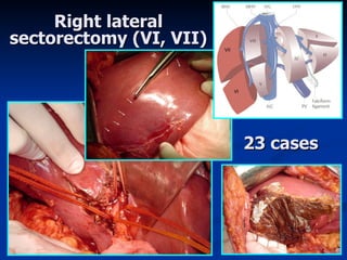 Right lateral sectorectomy (VI, VII) 23 cases 