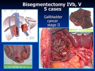 Bisegmentectom y  IVb, V  5 ca ses Gallbladder  cancer  sta ge  II 
