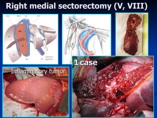 Right medial sectorectomy  (V, VIII)   1   case   Inflammatory tumor 