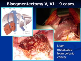 Bisegmentectom y  V, VI – 9 ca ses Liver m etasta sis   from  colonic  cancer   S IV S VIII S IV S VIII 