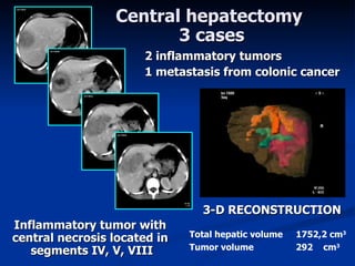 I nflam m ator y tumor with central necrosis located in  segment s  IV, V, VIII Total hepatic volume 1752,2 cm 3 Tumor volume 292  cm 3 3-D RECONSTRUCTION C entral  hepatectomy   3 ca ses 2 inflammatory tumors 1 metastasis from colonic cancer 