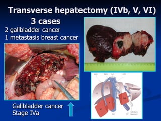 Transverse hepatectomy  (IVb, V, VI) Gallbladder  cancer Sta ge  IVa 3 cases 2  gallbladder  cancer 1 metasta sis breast cancer 