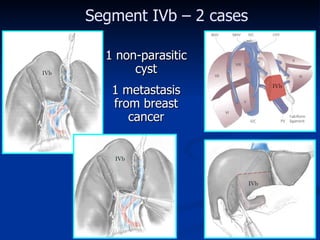 Segment IV b – 2 cases 1  non-parasitic cyst 1  metastasis from breast cancer IVb IVb IVb IVb 