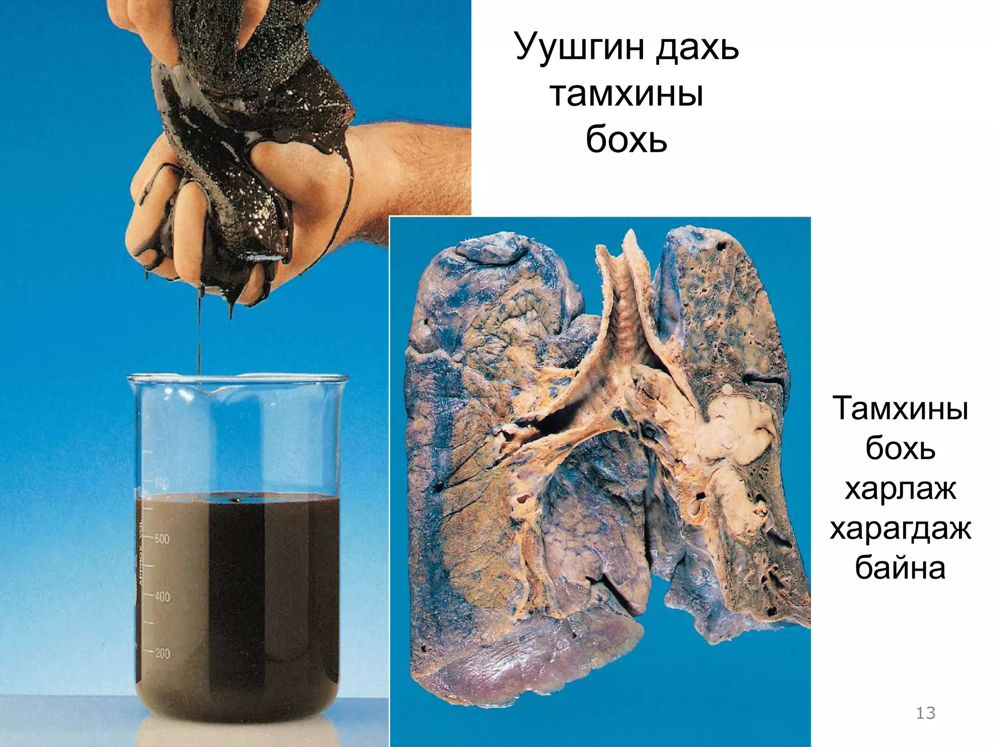 Уушгин дахь
  тамхины
    бохь




              Тамхины
                 бохь
               харлаж
              харагдаж
                байна



                  13
 