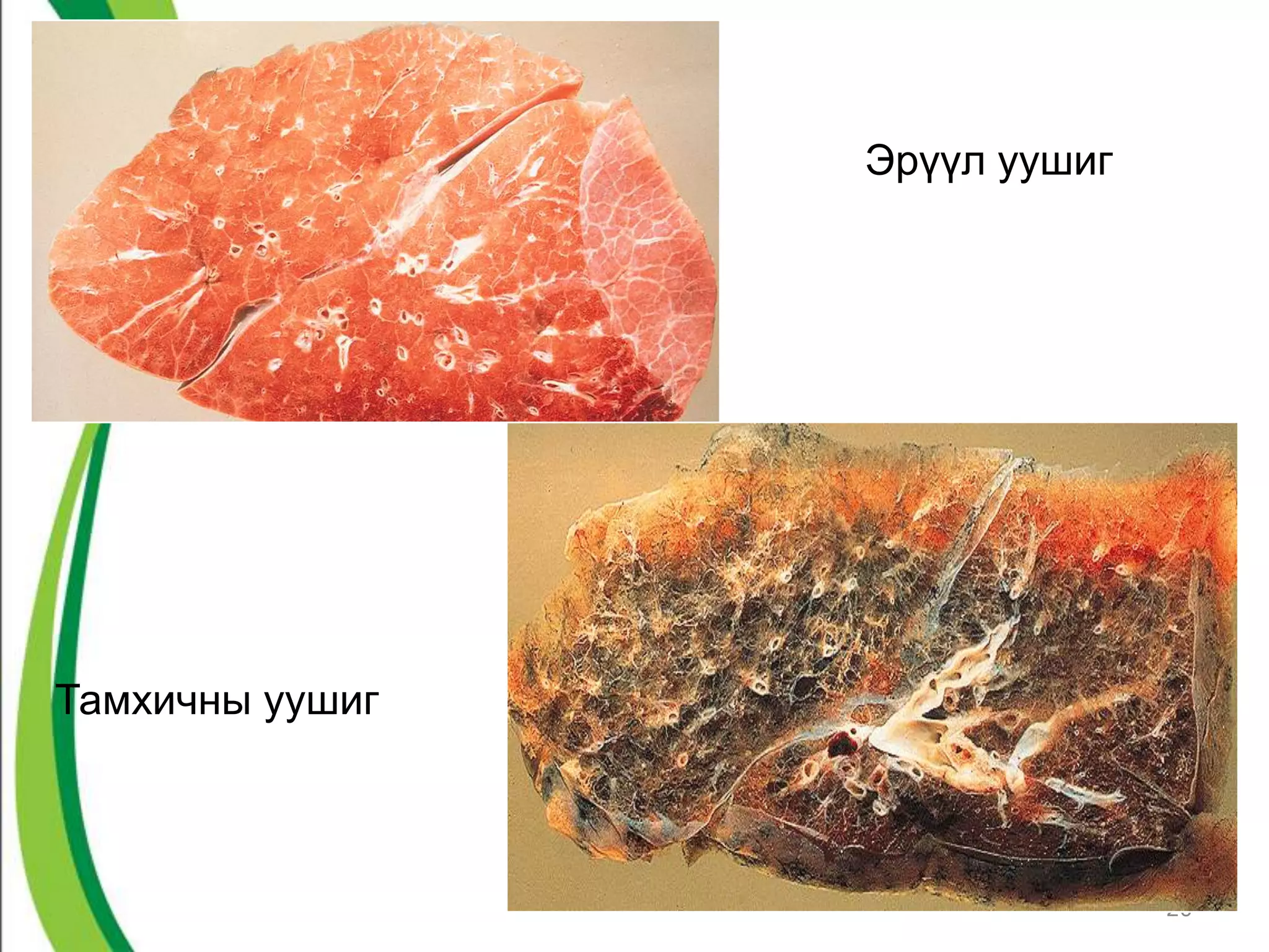 Эрүүл уушиг




Тамхичны уушиг



                               20
 