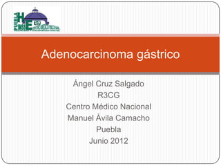 Ángel Cruz Salgado
R3CG
Centro Médico Nacional
Manuel Ávila Camacho
Puebla
Junio 2012
Adenocarcinoma gástrico
 