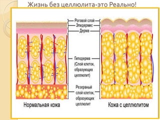 Жизнь без целлюлита-это Реально!

 