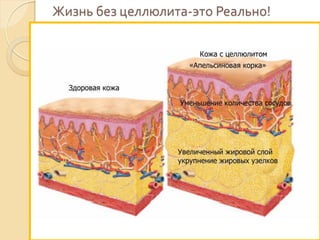 Жизнь без целлюлита-это Реально!

 