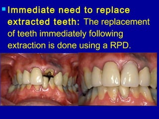 Immediate Rpd Denture 15. introduction to removable partial dentures | PPT