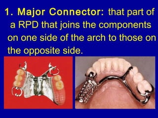Split Major Connector Rpd 15. introduction to removable partial dentures | PPT