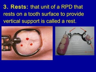 Rest In Rpd 15. introduction to removable partial dentures | PPT