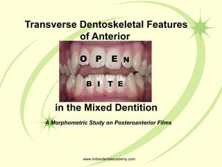 Transverse Dentoskeletal Features
of Anterior
in the Mixed Dentition
A Morphometric Study on Posteroanterior Films
O P E N
B I T E
www.indiandentalacademy.com
 