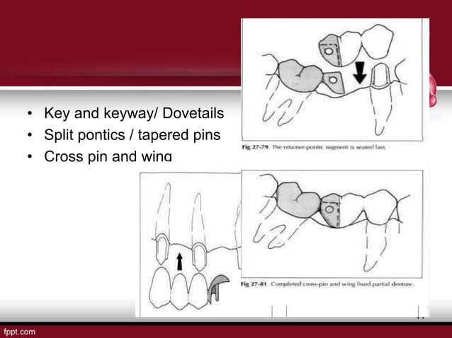 stress-breakers-in-prosthodontics-ppt