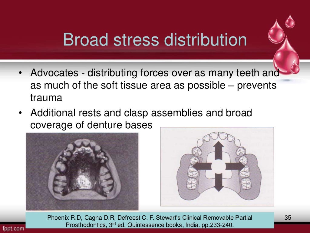 stress breakers in prosthodontics