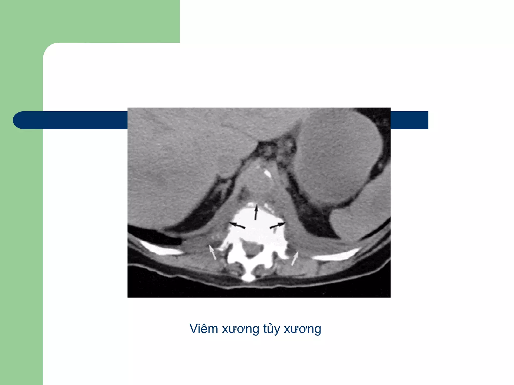 Viêm xương tủy xương
 