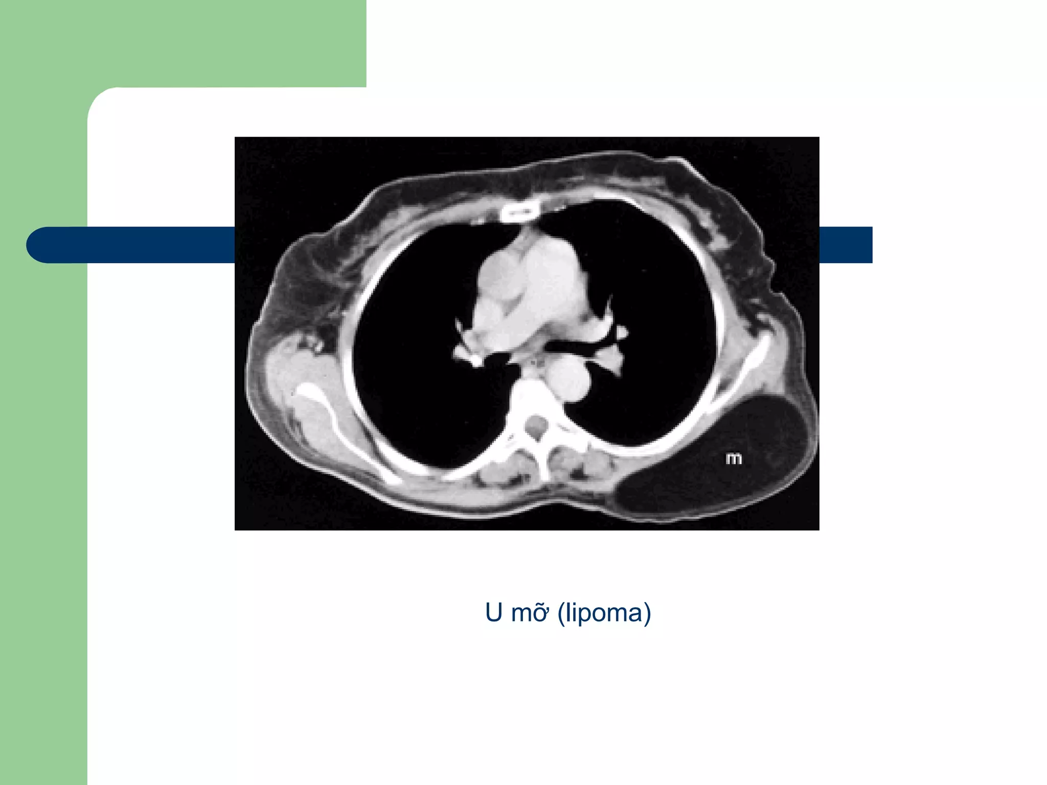 U mỡ (lipoma)
 
