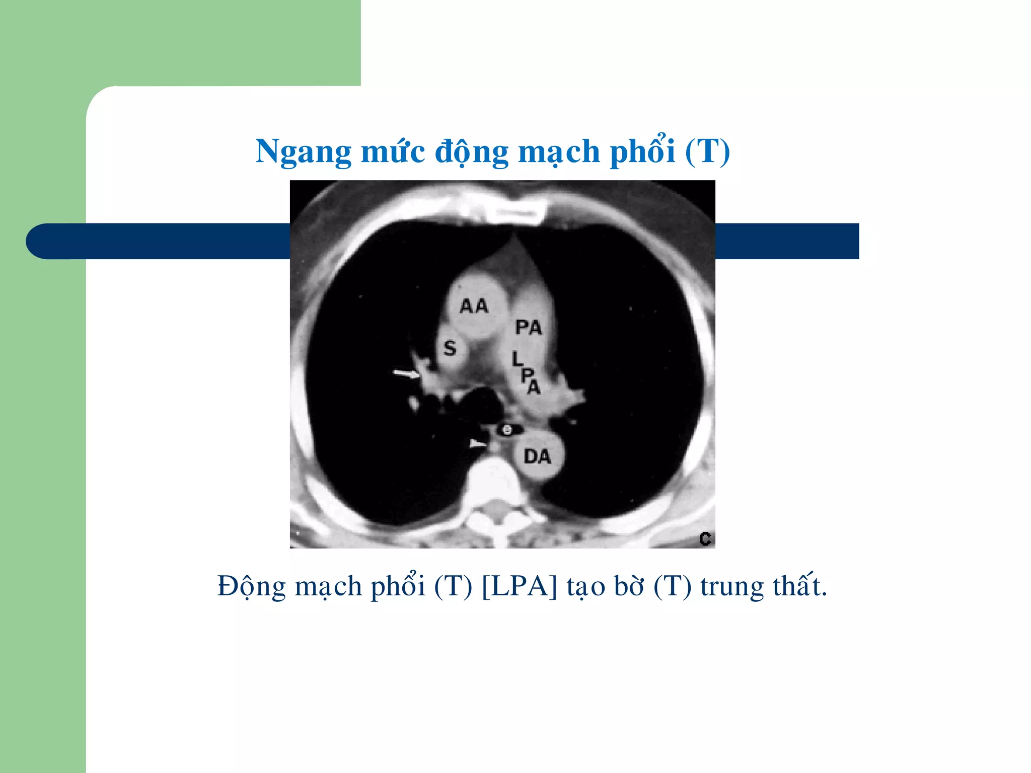 Ngang möùc ñoäng maïch phoåi (T)
•Ñoäng maïch phoåi (T) [LPA] taïo bôø (T) trung thaát.
 