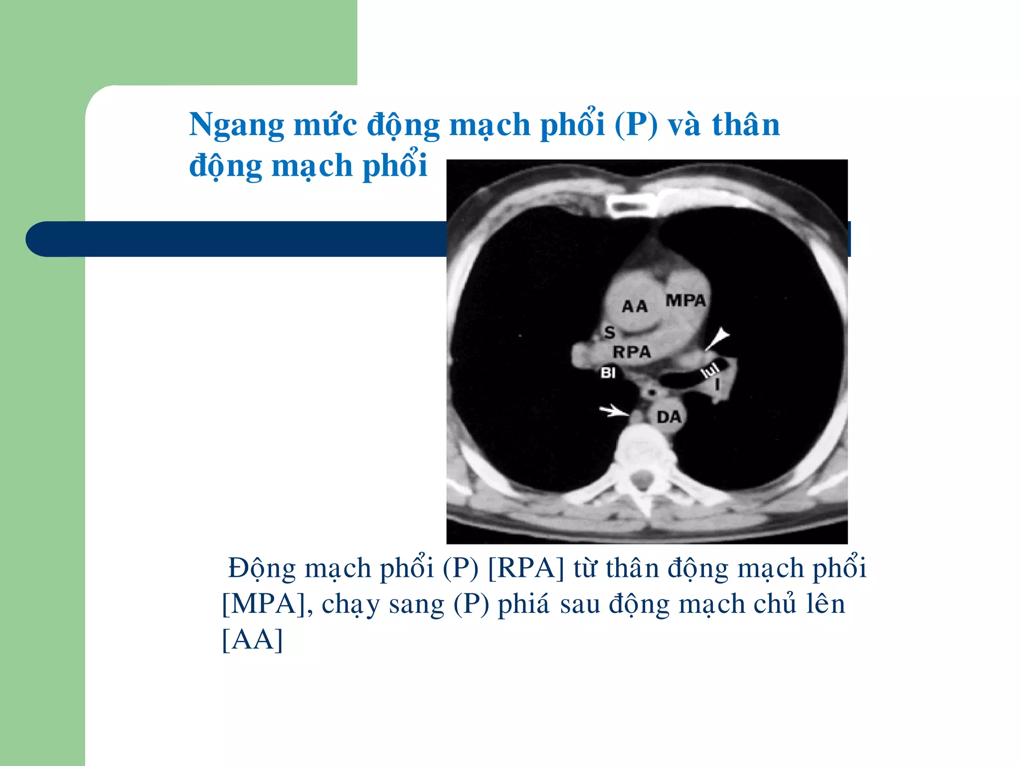 Ngang möùc ñoäng maïch phoåi (P) vaø thaân
ñoäng maïch phoåi
•Ñoäng maïch phoåi (P) [RPA] töø thaân ñoäng maïch phoåi
[MPA], chaïy sang (P) phiaù sau ñoäng maïch chuû leân
[AA]
 