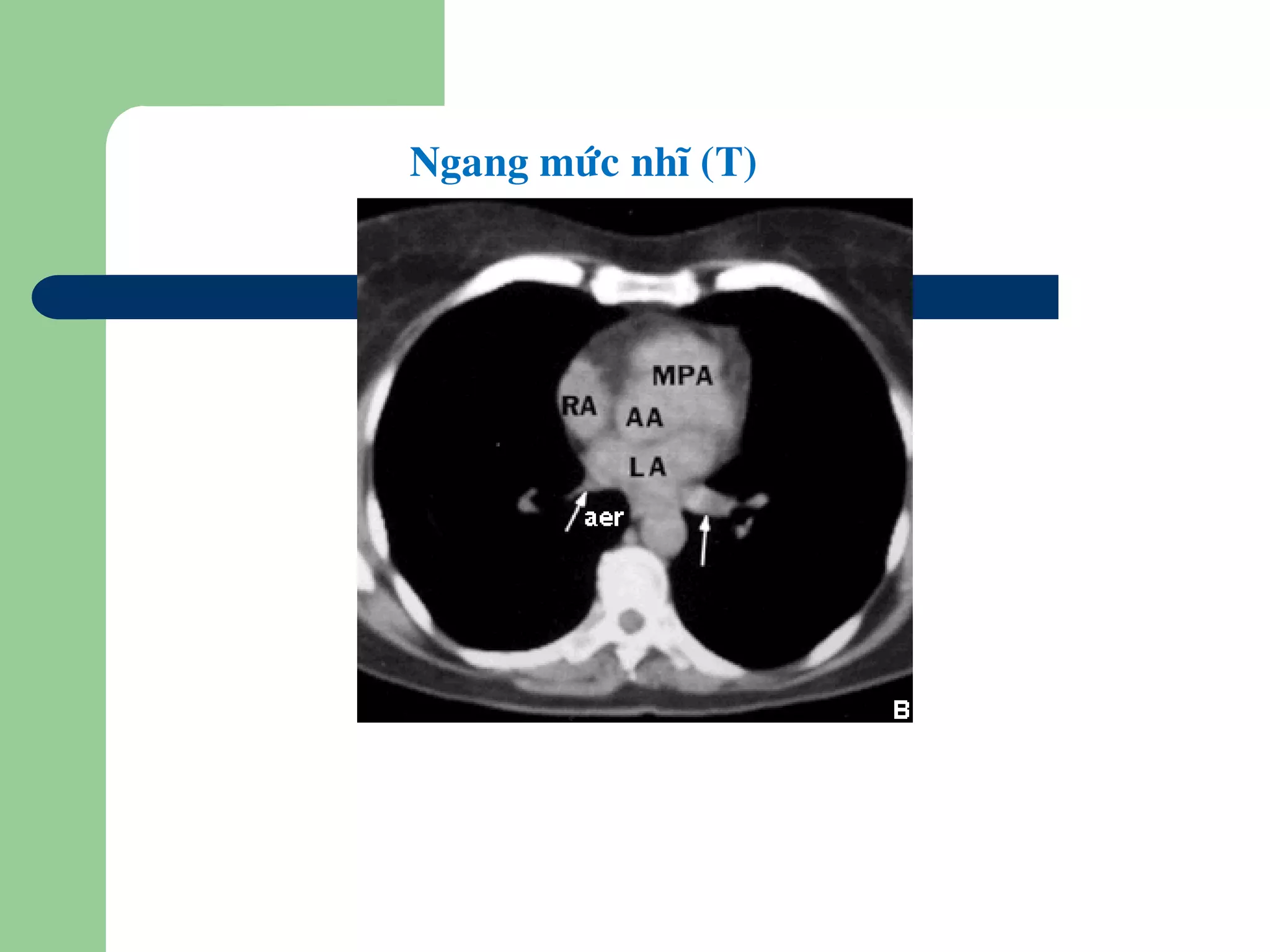 Ngang möùc nhó (T)
 