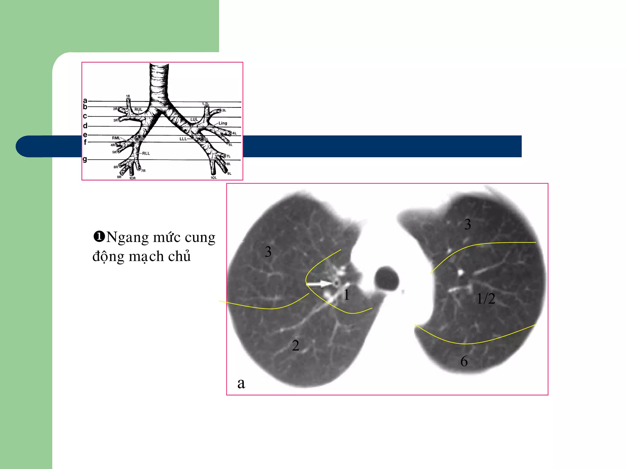 Ngang möùc cung
ñoäng maïch chuû 3
3
2
1/21
6
a
 