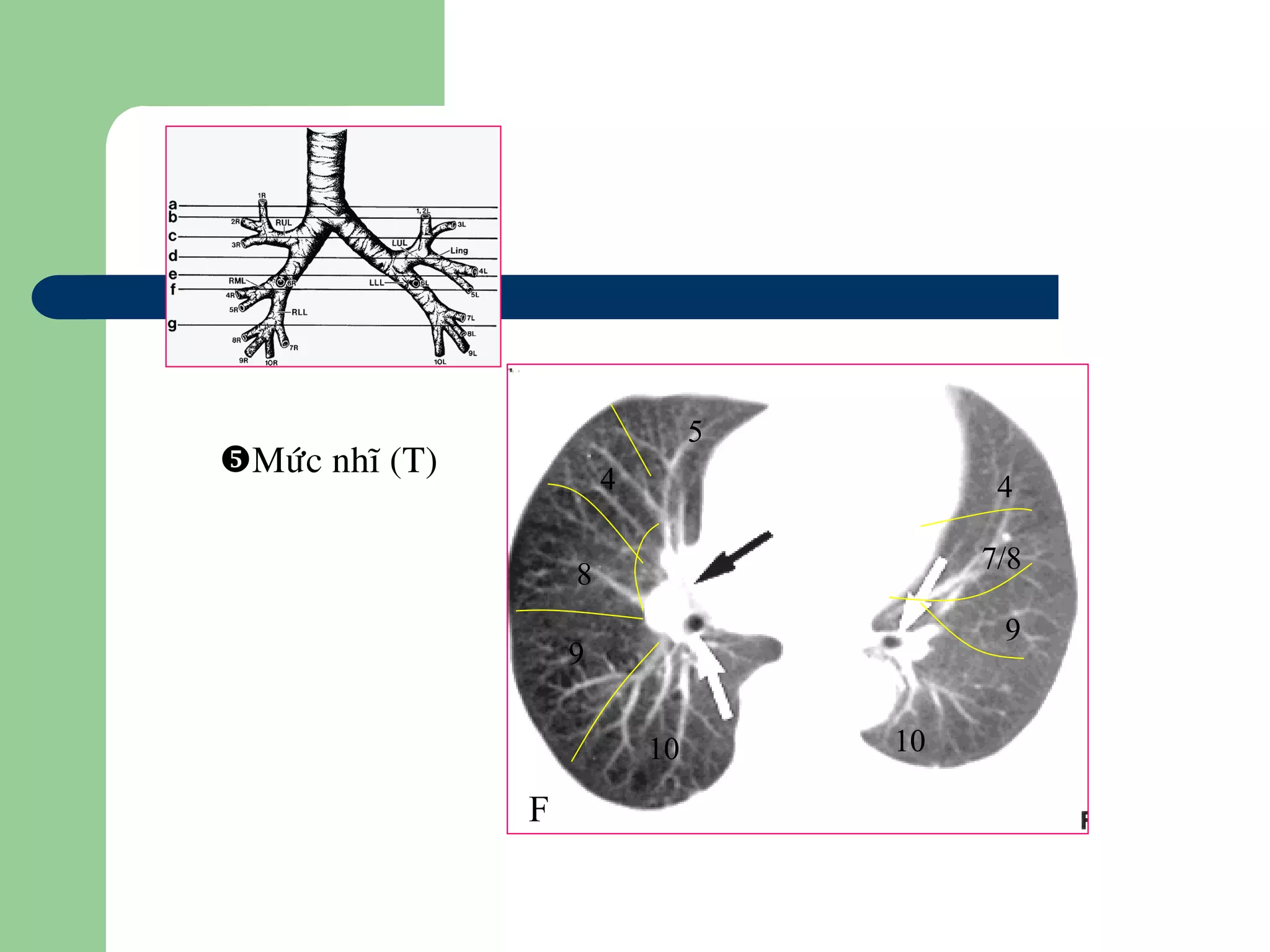 Möùc nhó (T)
10
5
4
8
9
10
4
7/8
9
F
 