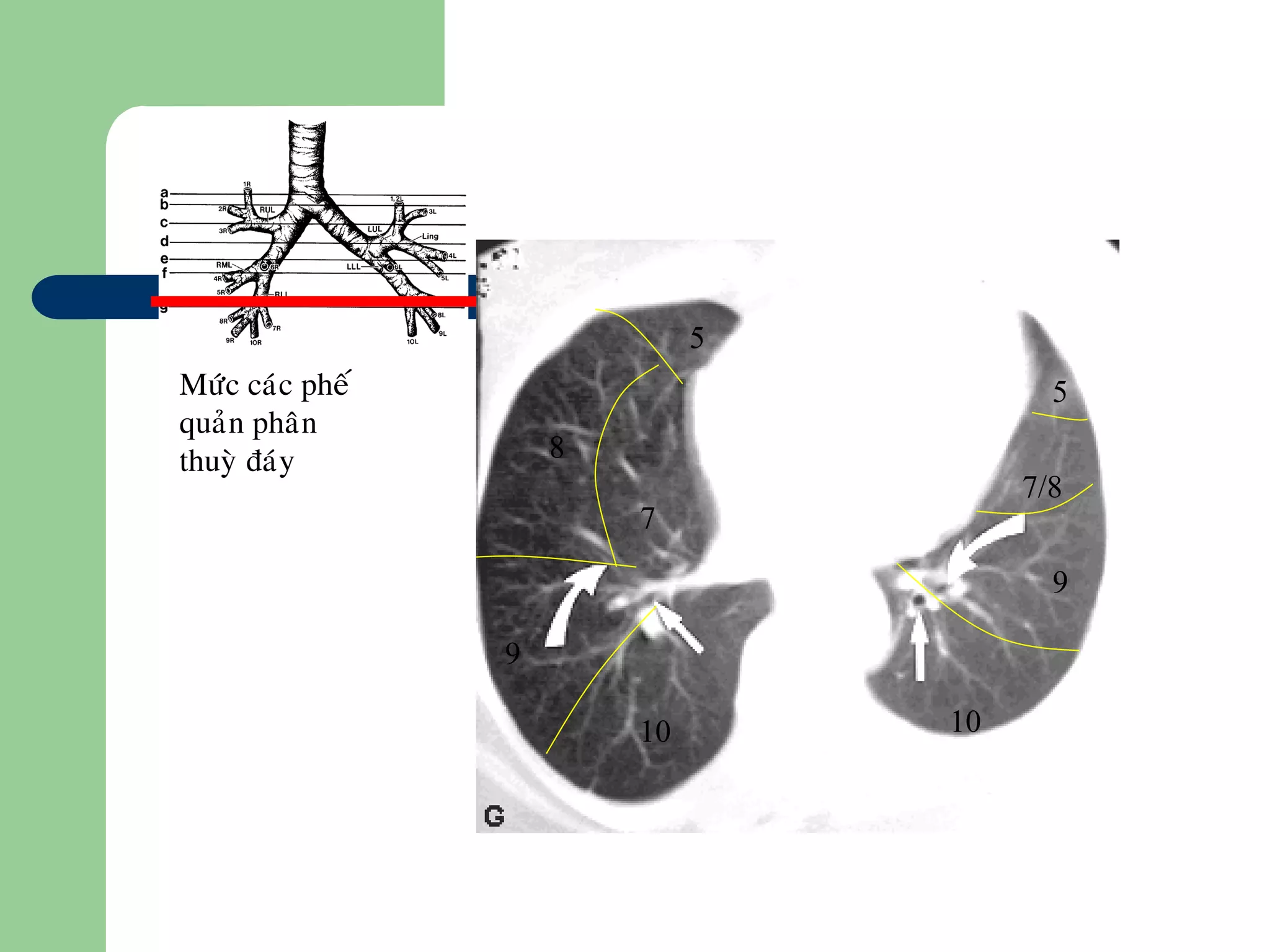 Möùc caùc pheá
quaûn phaân
thuyø ñaùy
10
5
8
9
10
7/8
7
5
9
 