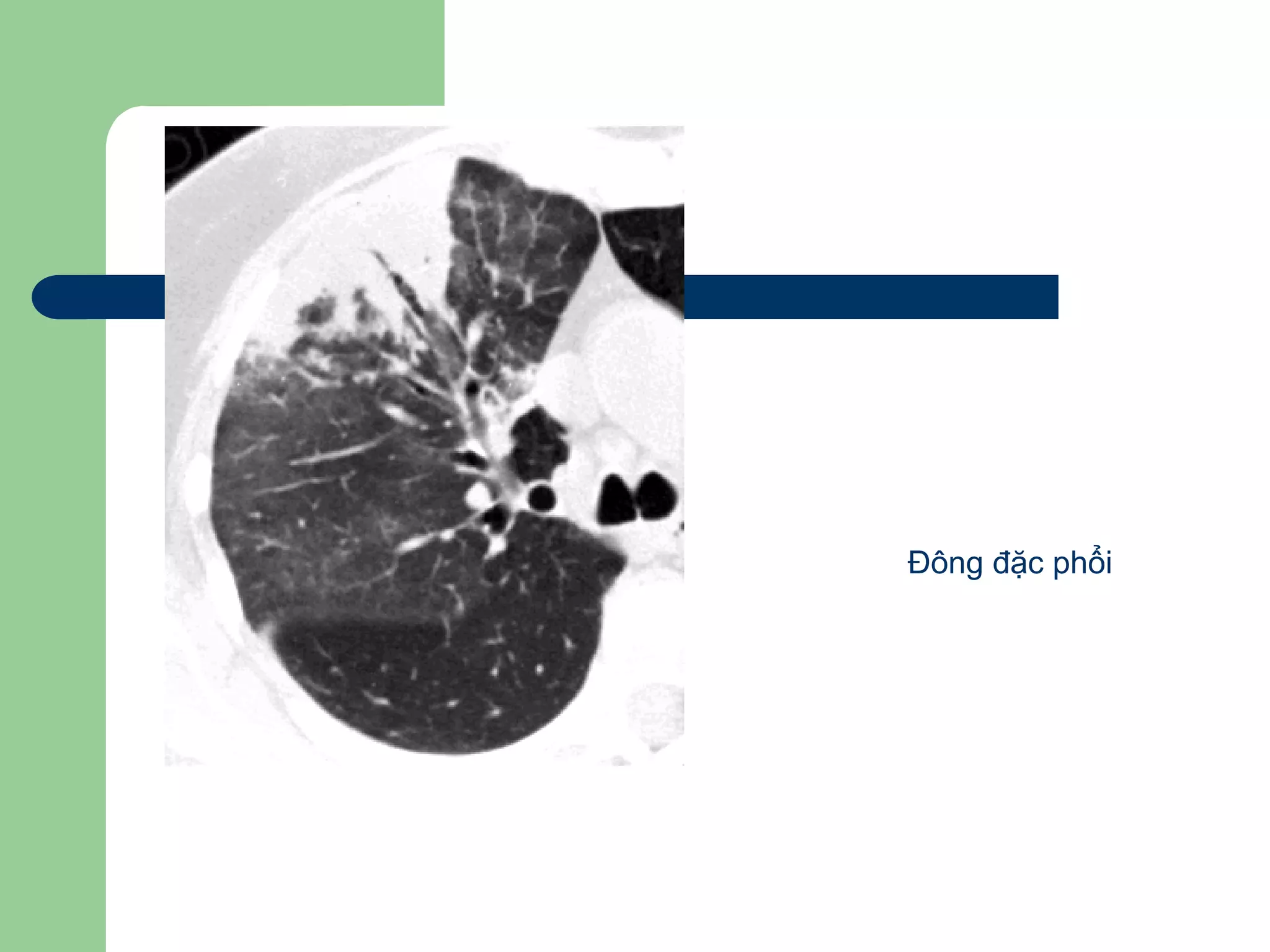 Đông đặc phổi
 