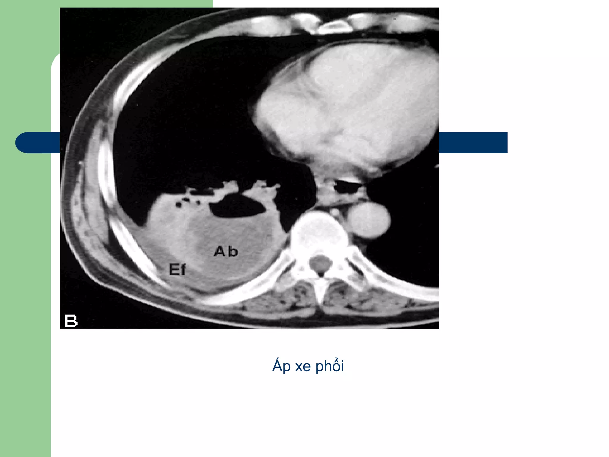 Aùp-xe phoåi
Áp xe phổi
 