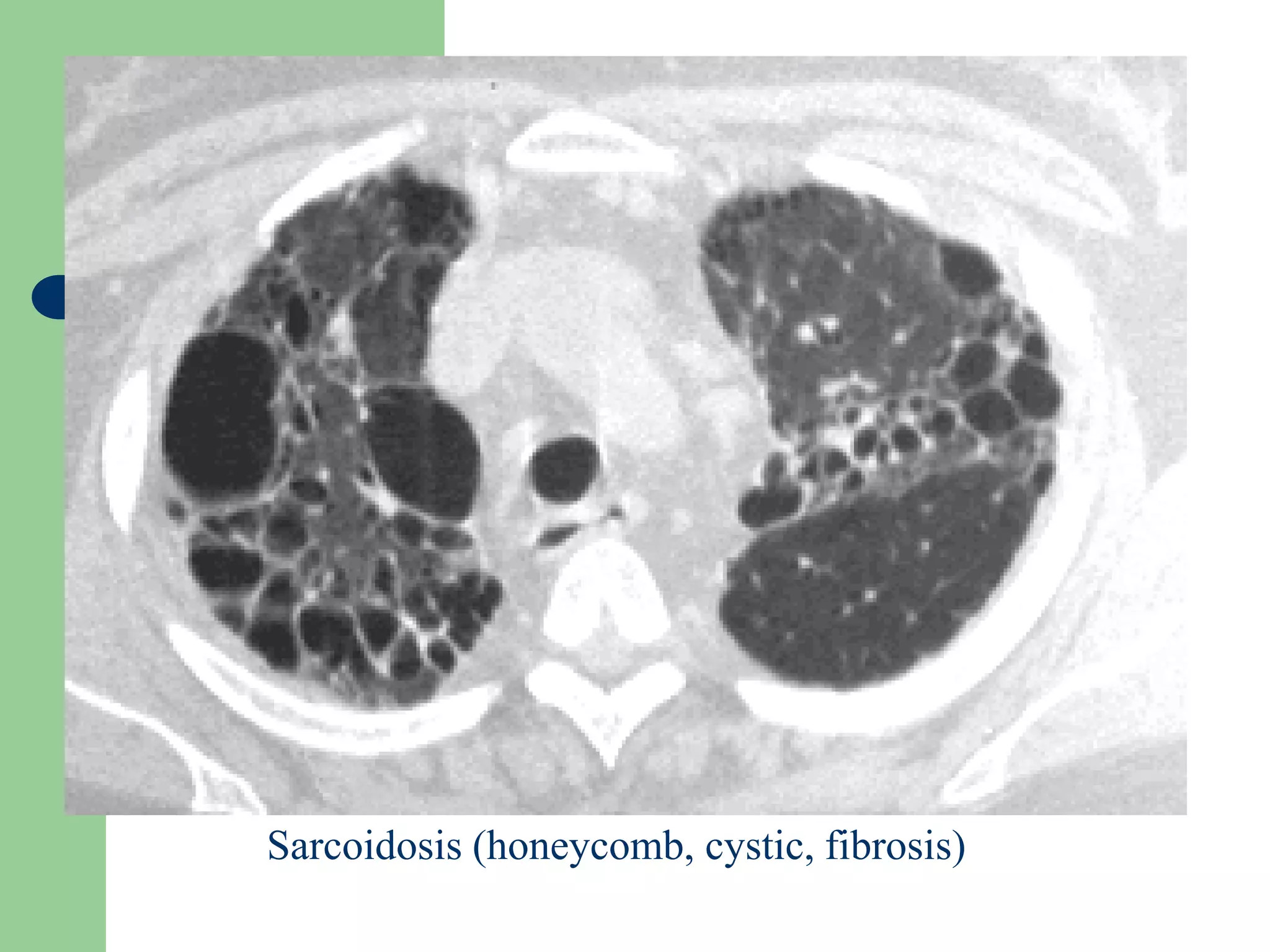 Sarcoidosis (honeycomb, cystic, fibrosis)
 