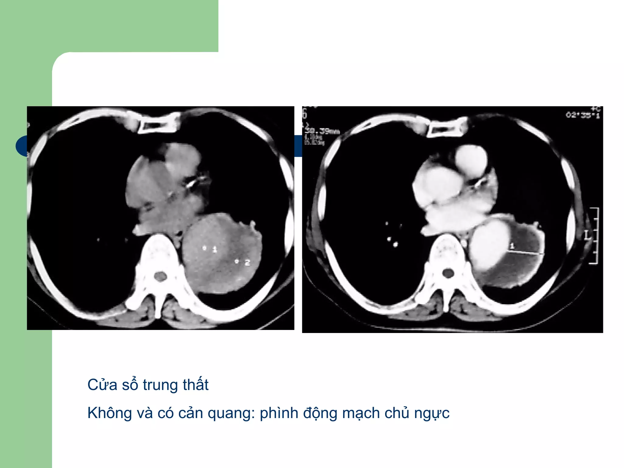 Cửa sổ trung thất
Không và có cản quang: phình động mạch chủ ngực
 