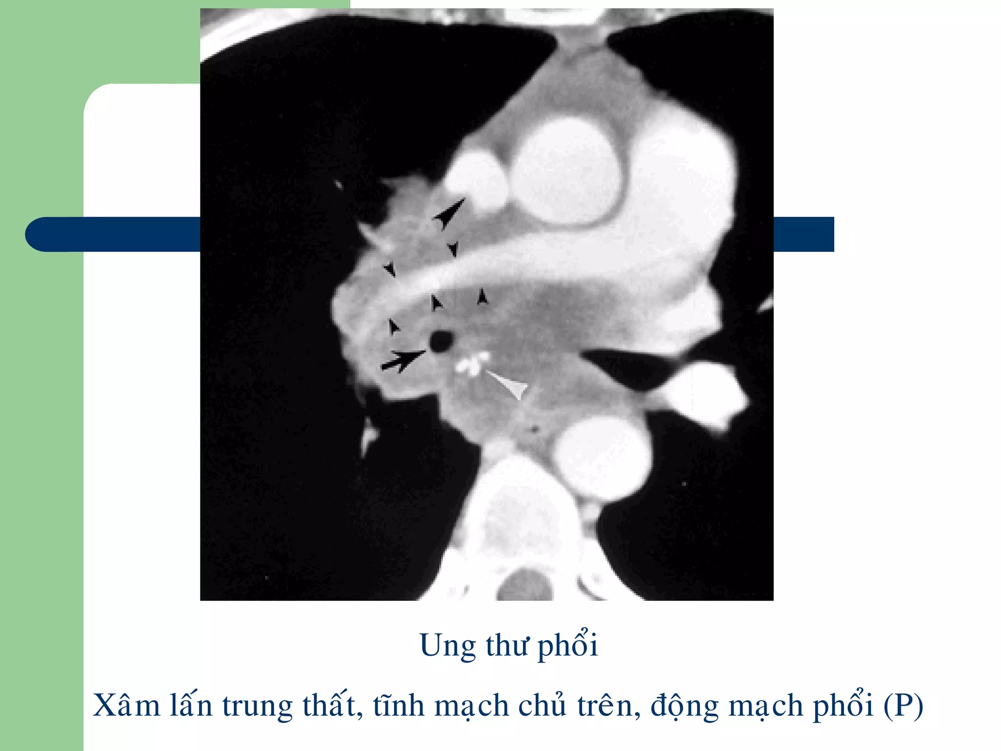 Ung thö phoåi
Xaâm laán trung thaát, tónh maïch chuû treân, ñoäng maïch phoåi (P)
 