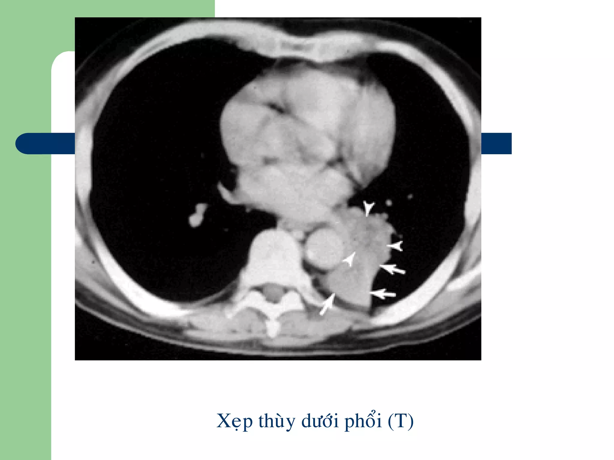 Xeïp thuøy döôùi phoåi (T)
 