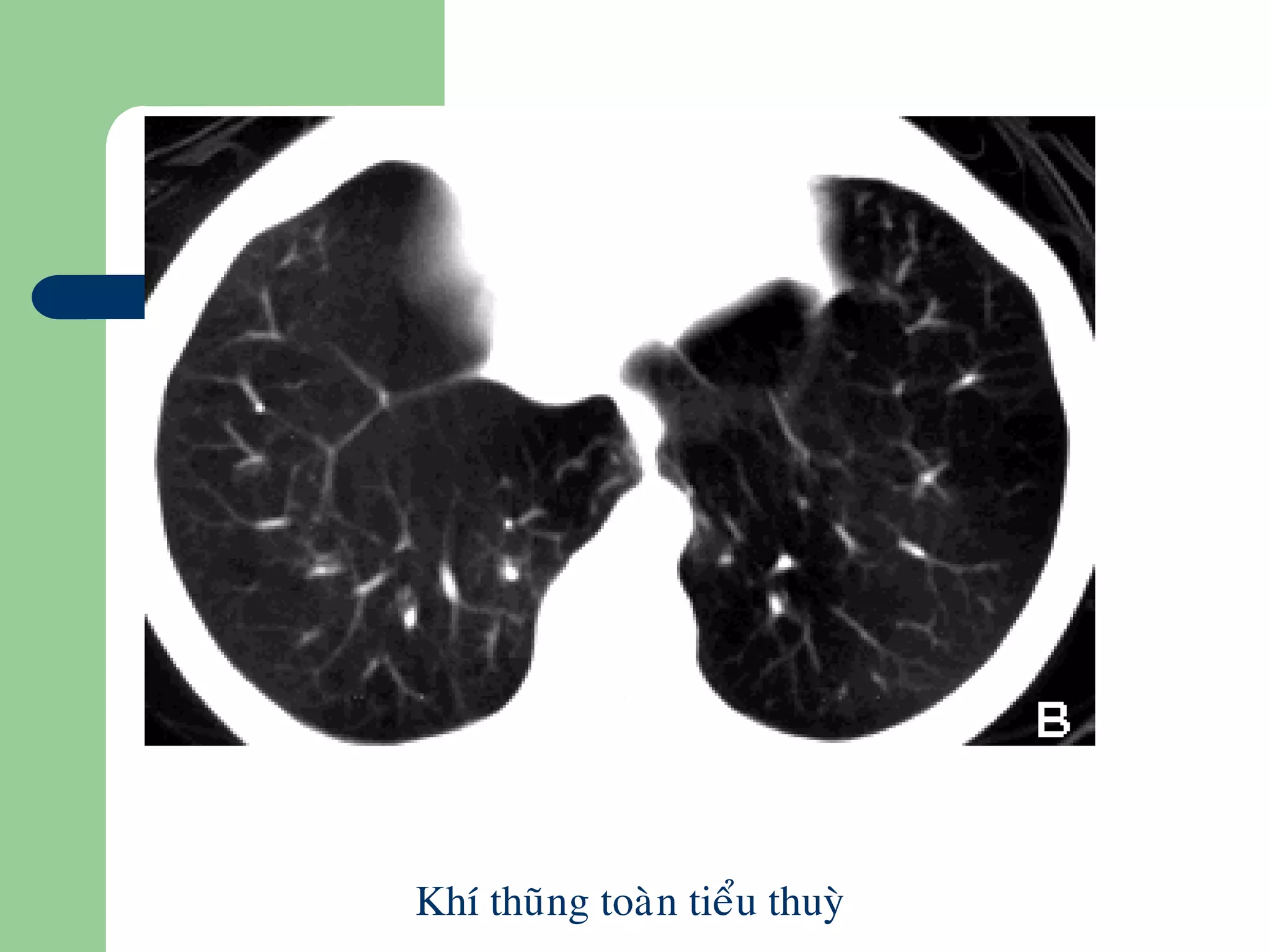 Khí thuõng toaøn tieåu thuyø
 