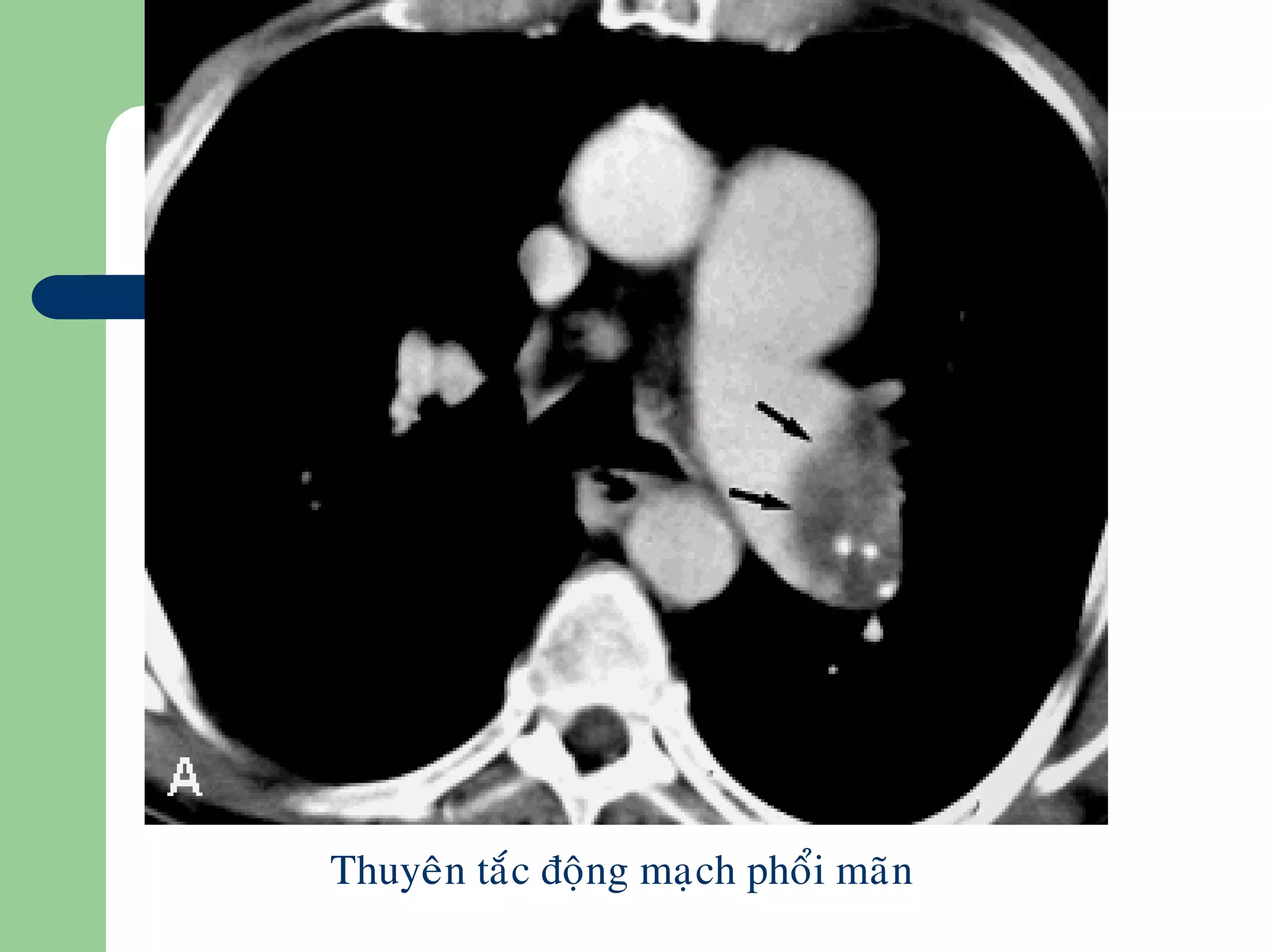 Thuyeân taéc ñoäng maïch phoåi maõn
 