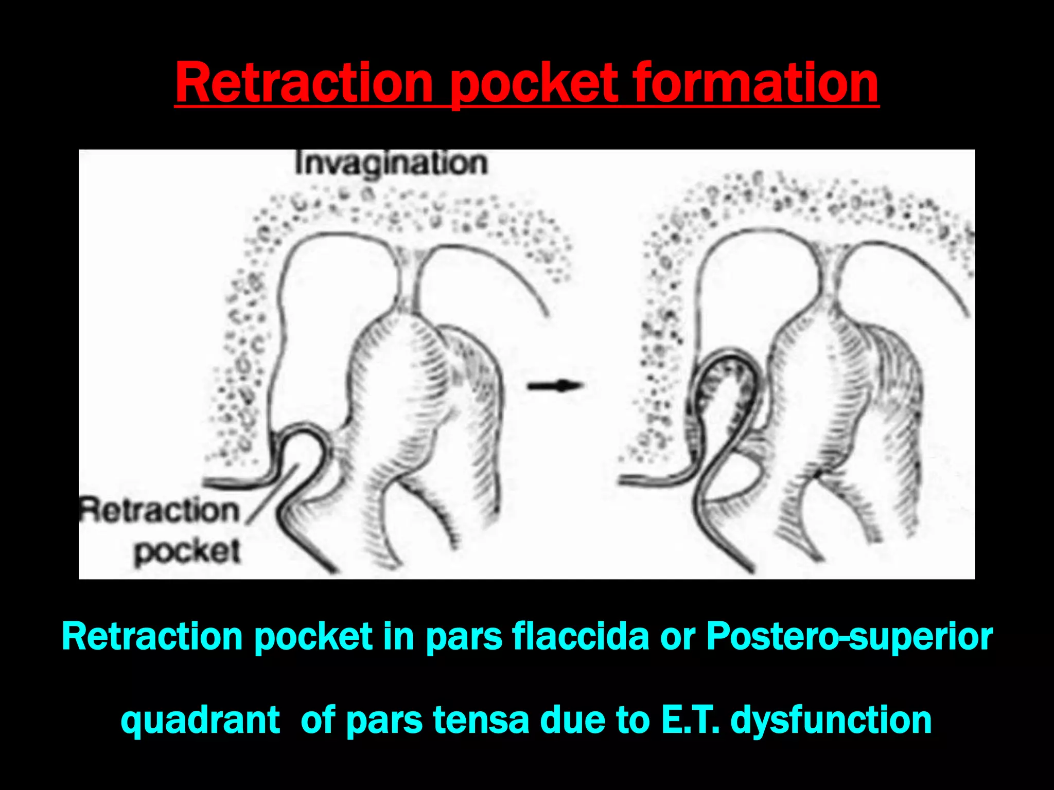 Retraction pocket formation
Retraction pocket in pars flaccida or Postero-superior
quadrant of pars tensa due to E.T. dysfunction
 