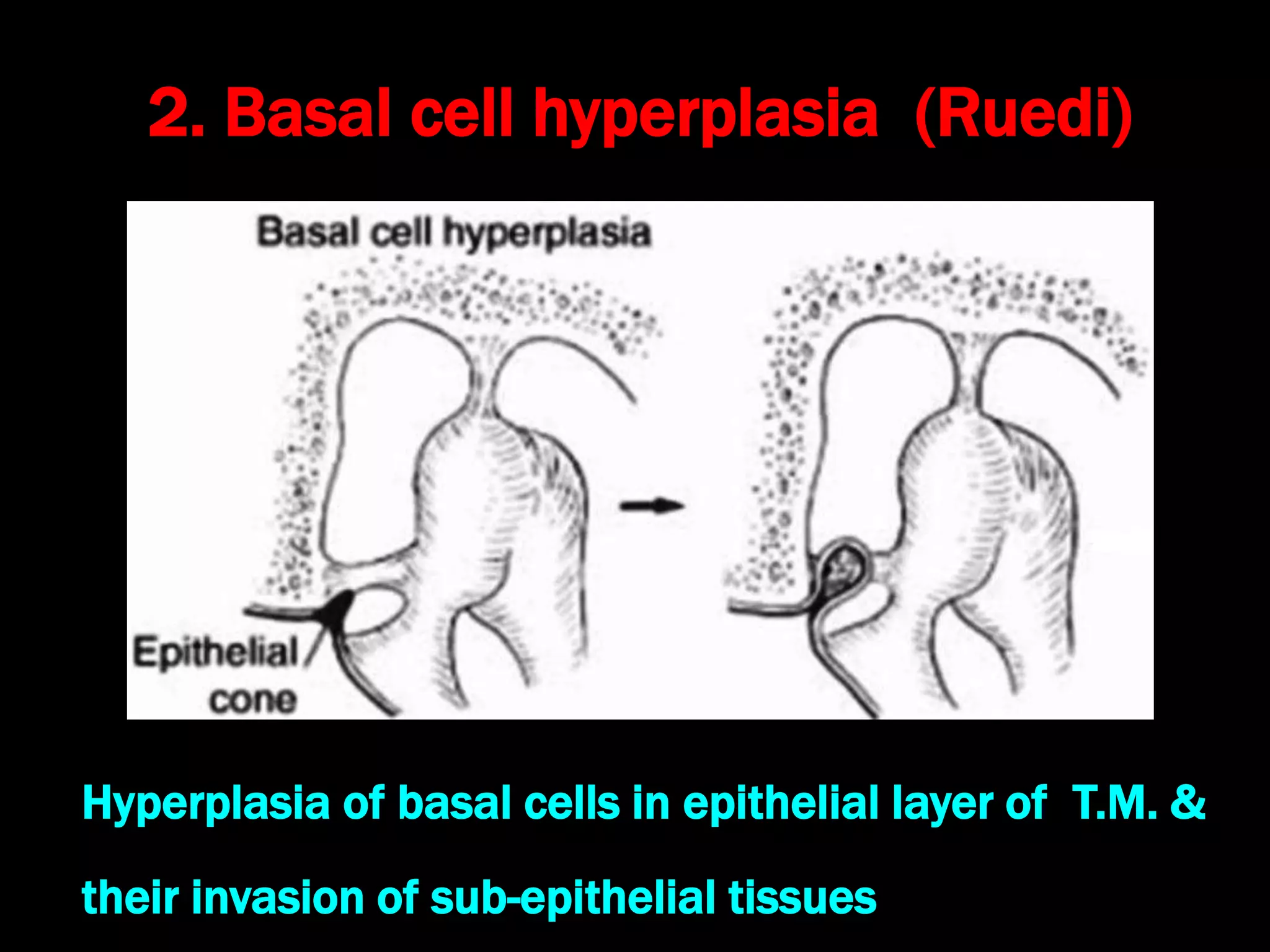 2. Basal cell hyperplasia (Ruedi)
Hyperplasia of basal cells in epithelial layer of T.M. &
their invasion of sub-epithelial tissues
 