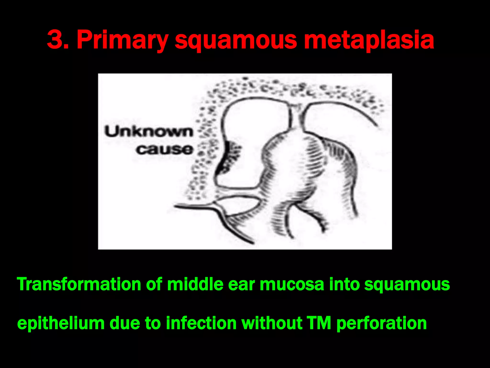 3. Primary squamous metaplasia
Transformation of middle ear mucosa into squamous
epithelium due to infection without TM perforation
 