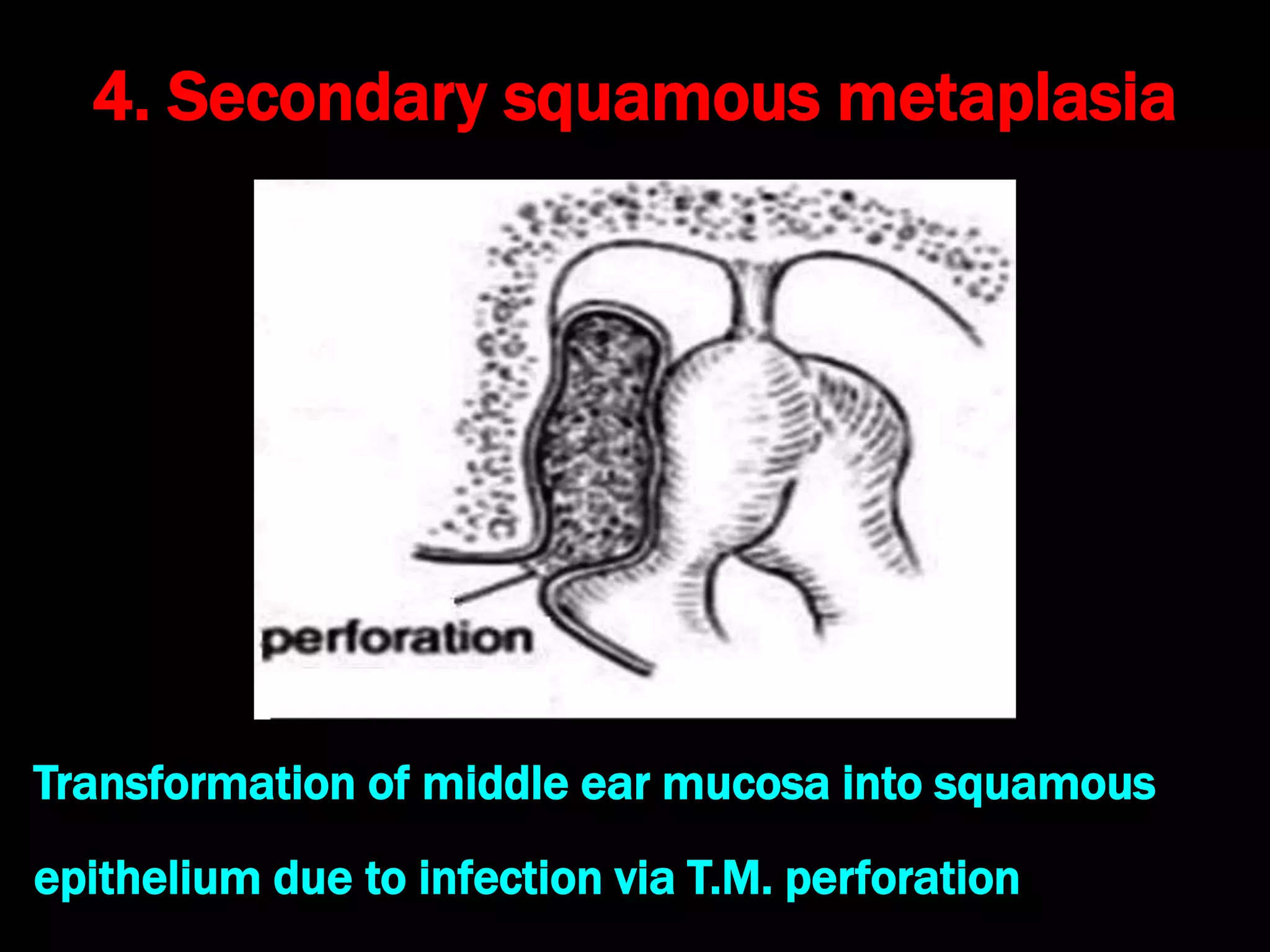 4. Secondary squamous metaplasia
Transformation of middle ear mucosa into squamous
epithelium due to infection via T.M. perforation
 