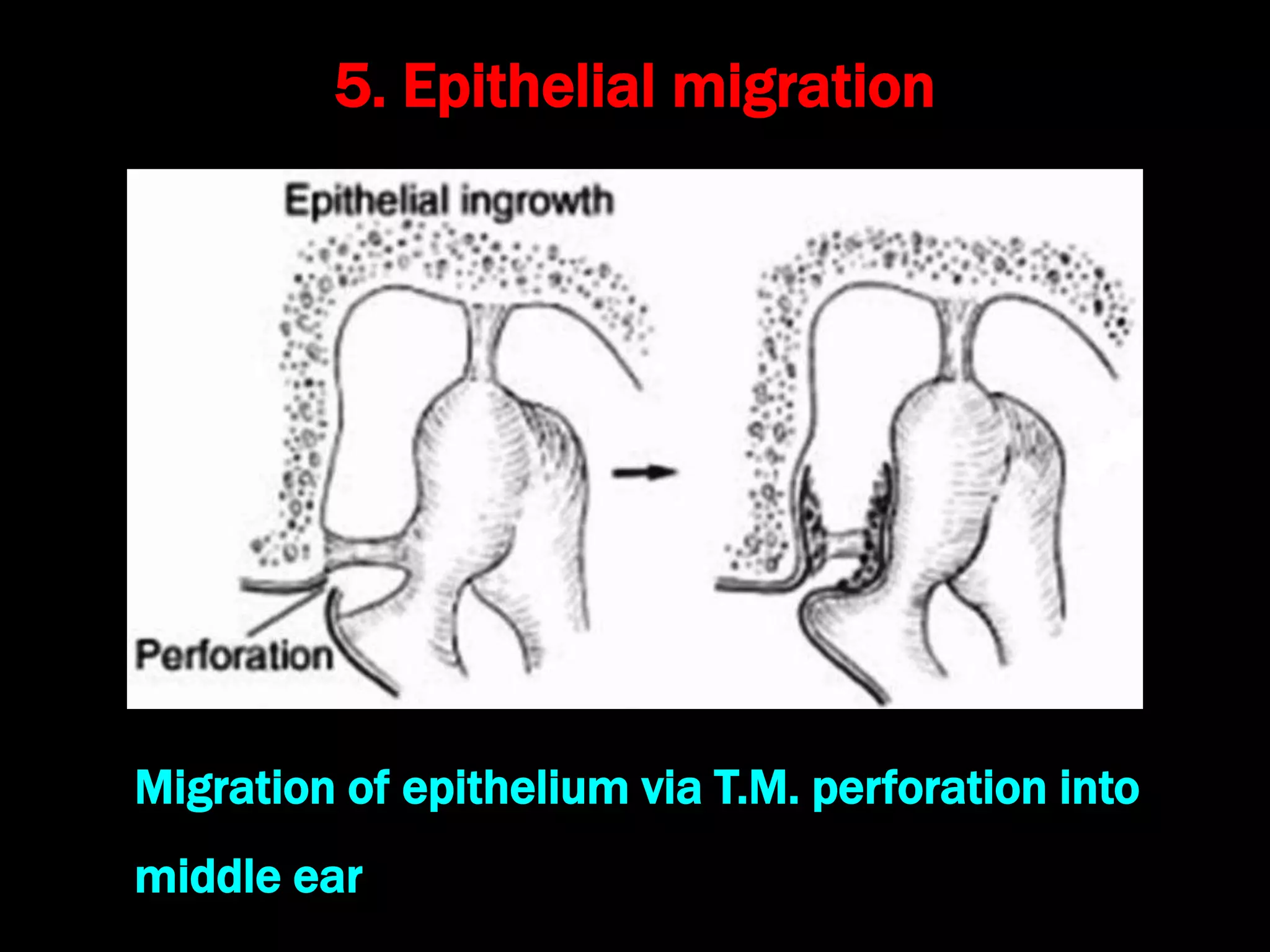 5. Epithelial migration
Migration of epithelium via T.M. perforation into
middle ear
 