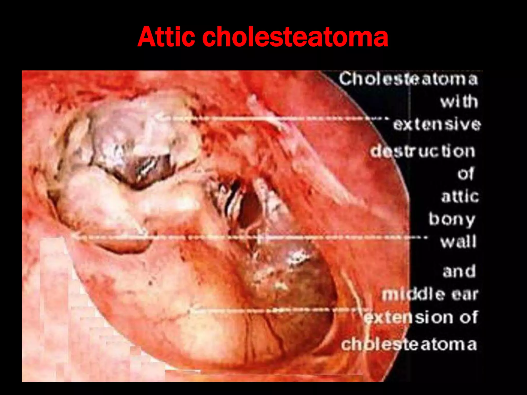 Attic cholesteatoma
 